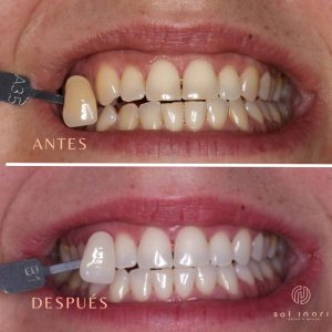 estetica dental en Benidorm