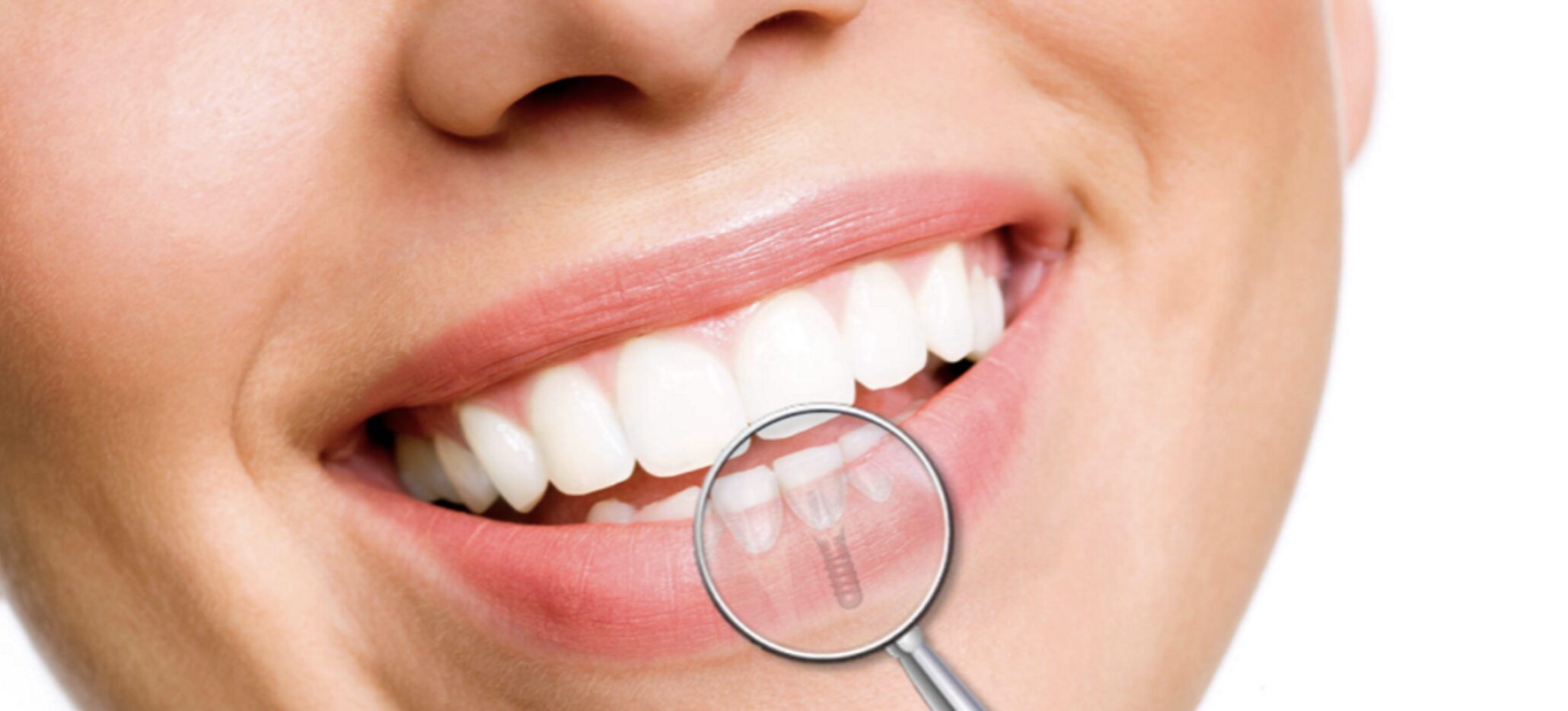implante dental benidorm