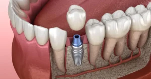 Cuánto duran los implantes dentales