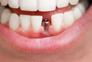 Cuánto duran los implantes dentales