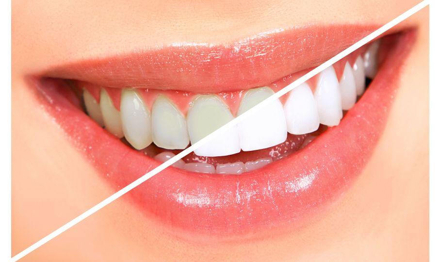 blanqueamiento dental