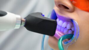 blanqueamiento dental