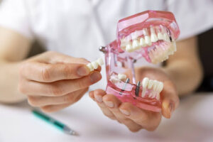 implantes dentales