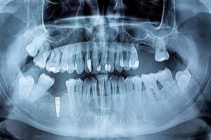 Implantes dentales en Benidorm