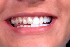 carillas dentales en benidorm