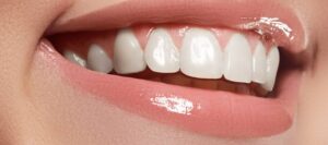 carillas dentales en benidorm
